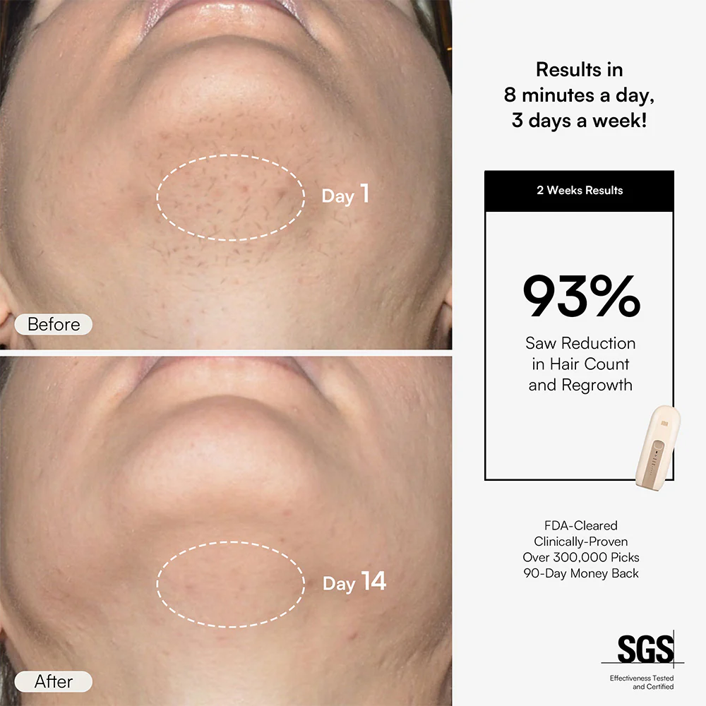 INIA FOND IPL Laser Hair Removal with Facial Mask - Image 5