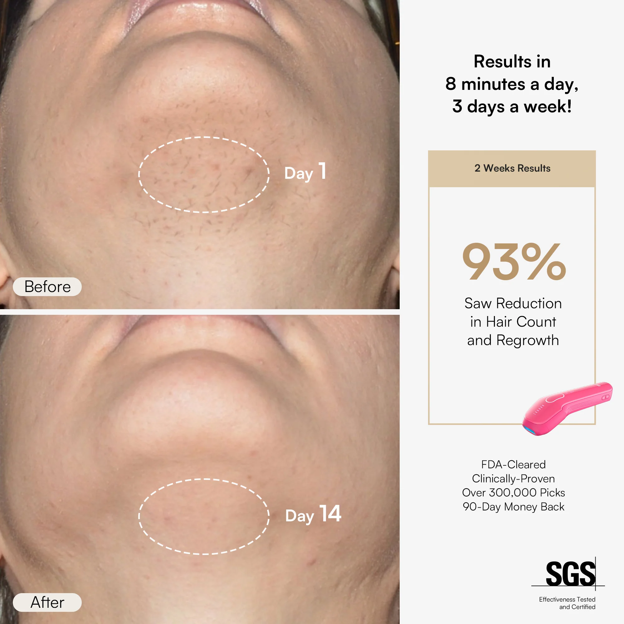 INIA HAUTE Pro IPL Laser Hair Removal Device - Image 7